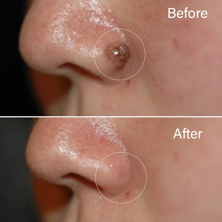 Flacone di VERRUFREE, trattamento per verruche e papillomi